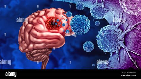 Glioma Tumore Del Cancro Come Cellule Maligne Focolaio Come Una