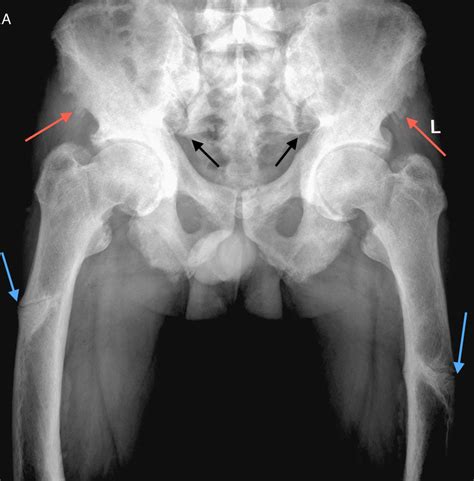 X-linked hypophosphatemia with enthesopathy | BMJ Case Reports