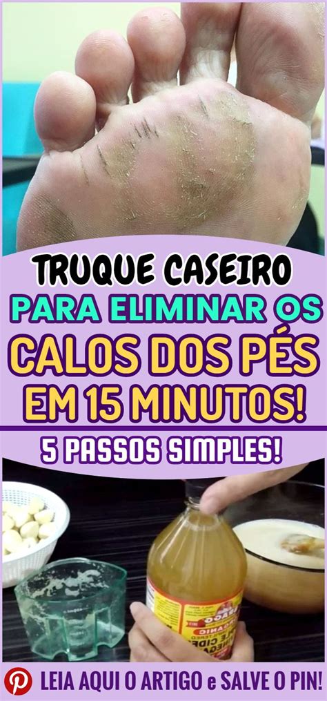 Veja Esse Truque Caseiro Para Eliminar Os Calos Dos P S Em Minutos