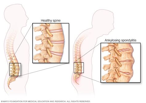 Ankylosing spondylitis - Symptoms and causes - Mayo Clinic