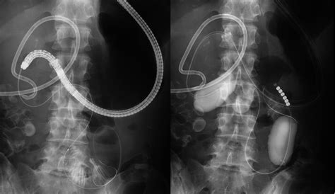 Technical Review Of Endoscopic Ultrasonography‐guided Gastroenterostomy