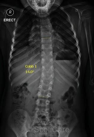 Treatment Of An Infantile Scoliosis Using A ScoliBrace McGinley