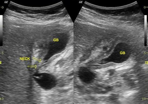 Normal Common Bile Duct Ultrasound