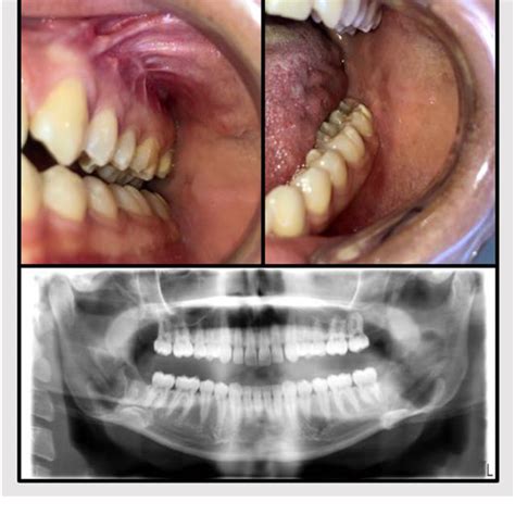 Top Intraoperative Maxillary Bottom Clinical View Of Mandibular