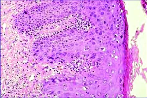 Photomicrograph Showing Stratified Squamous Epithelium Showing