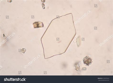 Uric Acid Crystals In Urine Infant