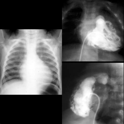 Pediatric Pulmonary Stenosis Pediatric Radiology Reference Article Pediatric Imaging