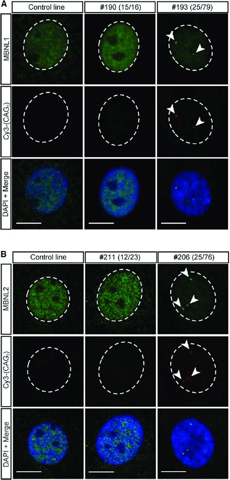 Mbnl And Mbnl Are Sequestered To Rna Foci In Corneal Endothelial