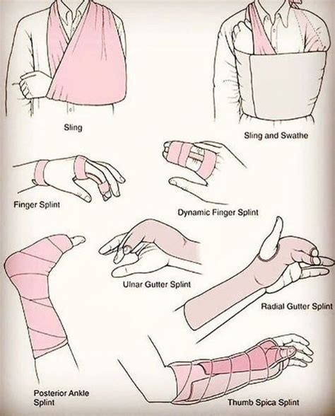 Types Of Slings And Splints Sling And Swathe Medical Videos Medical