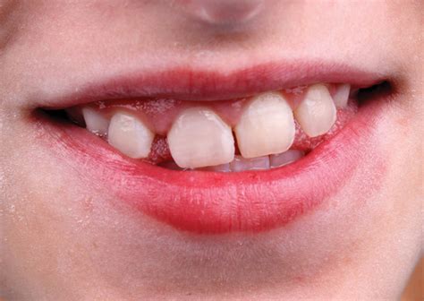 Esthetics and the Mixed Dentition - A Responsible Solution