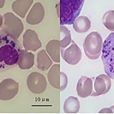 Skin Biopsy Showing Coarse Melanin Pigment In The Epidermis Source