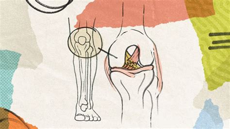 Acl Injuries Plague Womens Soccer Cnn