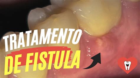 COMO RESOLVER UMA FÍSTULA ASSOCIADA AO CANAL DO DENTE Endolovers