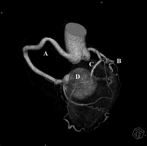 Multiple Coronary Arteriovenous Fistulas To The Coronary Sinus With An