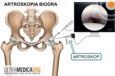 Artroskopia Biodra Stawu Biodrowego Ultramedica Krak W