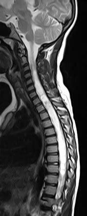 Spinal Cord Astrocytoma Image Radiopaedia Org