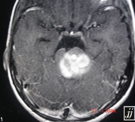 Basilar Artery Thrombosis Radiopaedia