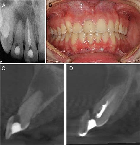 Figure 1 From Comparison Of Endodontic Diagnosis And Treatment Planning