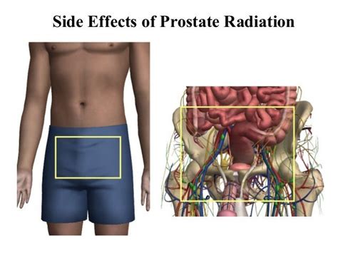 Radiotherapy For Prostate Cancer