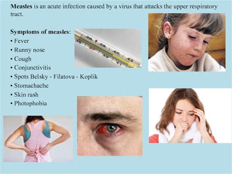 Measles Symptoms Treatment Prevention