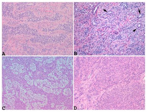 Diagnostics Free Full Text Uterine Tumor Resembling Ovarian Sex