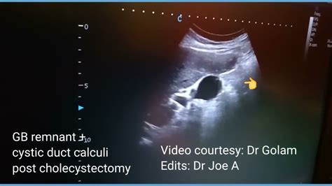 Post Cholecystectomy Or Surgical Removal Of Gallbladder Calculi In Gb