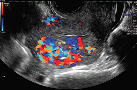 Endovascular Today Diagnosis And Treatment Of Uterine And Pelvic