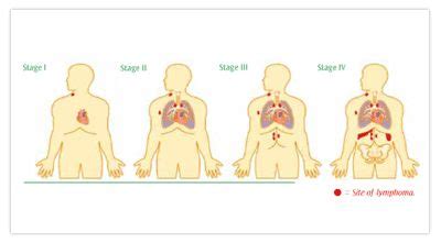 Lymphoma: Lymphoma Stages