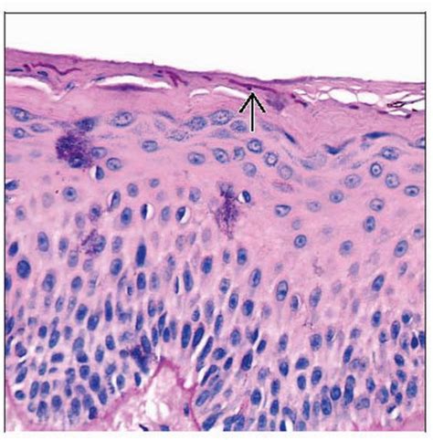 Dermatophytosis