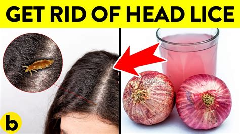 Top Home Remedies To Get Rid Of Head LICE Nits Sushmita's, 44% OFF