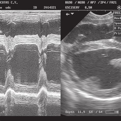 A Right Parasternal Long Axis View Of The Heart Base Echocardiographic