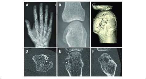 Conventional Radiography A B And Hr Pqct Imaging C E From A Download Scientific Diagram