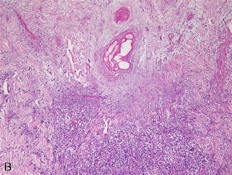 Histopathologic Finding Showing A Wedge Shaped Dermal Infarct With A