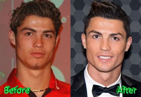 Cristiano Ronaldos Before And After Plastic Surgery Photos Are