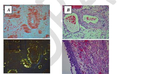 Histopathology Of Bladder Lesion A Congo Red Stain 20 X