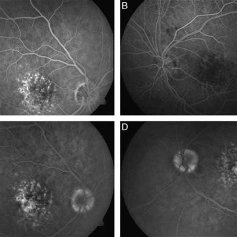 A Fluorescein Angiography Of The Right Eye In Halfway Time Showing