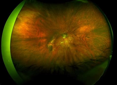 Tilted Disc Syndrome Complicated With Rpe Atrophy And Polypoidal
