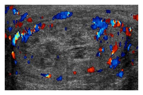 Postoperative Scrotal Ultrasound Download Scientific Diagram