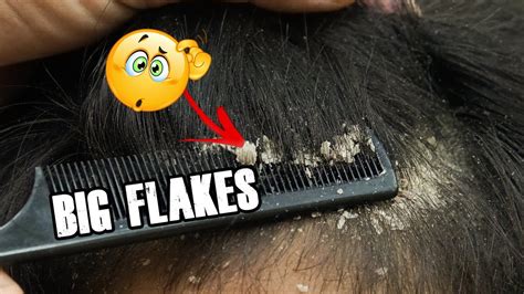 Wow Big Flakes Dandruff Scalp Scratching And Picking Satisfying