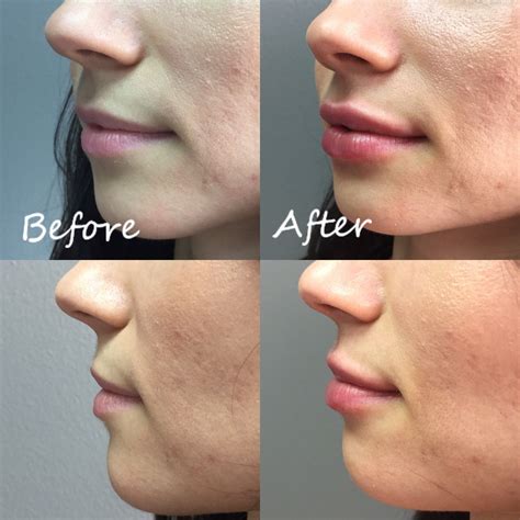 Lip Fillers Houston Tx Injectables Fillers Lip Fillers Lip Injections