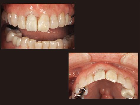 【モリタ】インプラント抜歯即時埋入による上顎前歯部審美修復治療｜デンタルマガジン｜歯科情報ポータルサイト デンタルプラザ