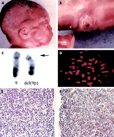 Deletion Of 9p Associated With Gonadal Dysfunction In 46xy But Not In