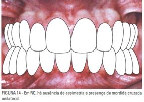 VIAGEM PELA ORTODONTIA Oclusão normal na denticao decídua Claudia e