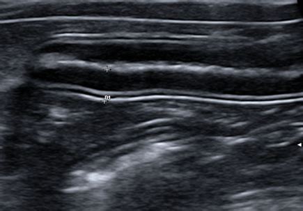 Vets Ultrasound Basics Flashcards Quizlet