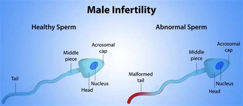 Male Infertility Introduction Welcomecure