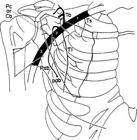 Figure 1 From Arterial Supply In The Human Pectoralis Minor Muscle Semantic Scholar