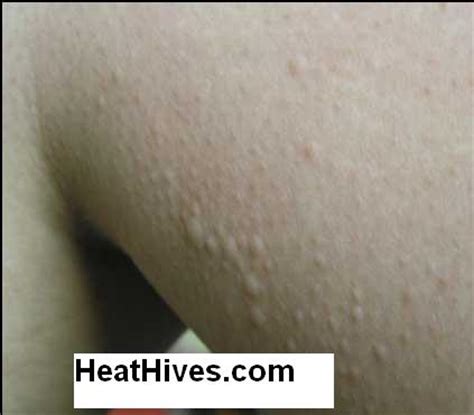 Physical Urticaria | Physical Hives | Treatment, Symptoms, Pictures, & Overview