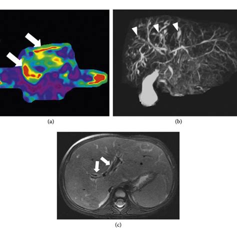 A Axial Mr Elastography Image Shows Increased Liver Stiffness White