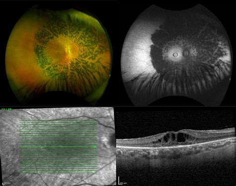 Retinitis Pigmentosa For Professionals Gene Vision