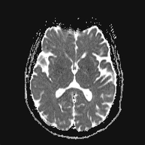 Clival Meningioma Image